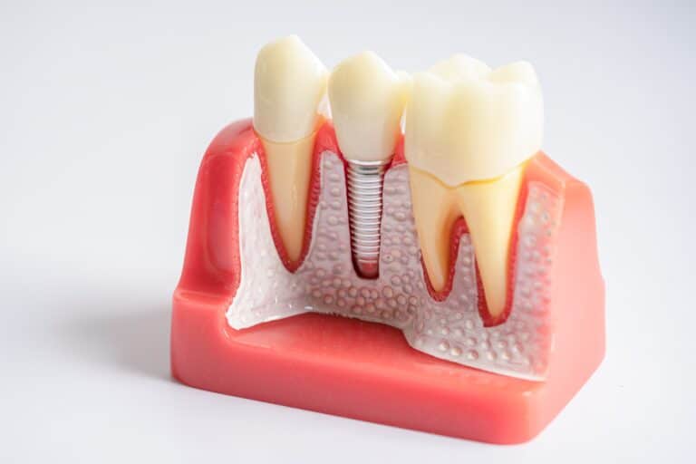 Dental Implants in Alamogordo
