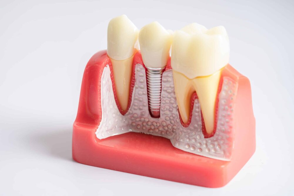 Dental Implants in Alamogordo